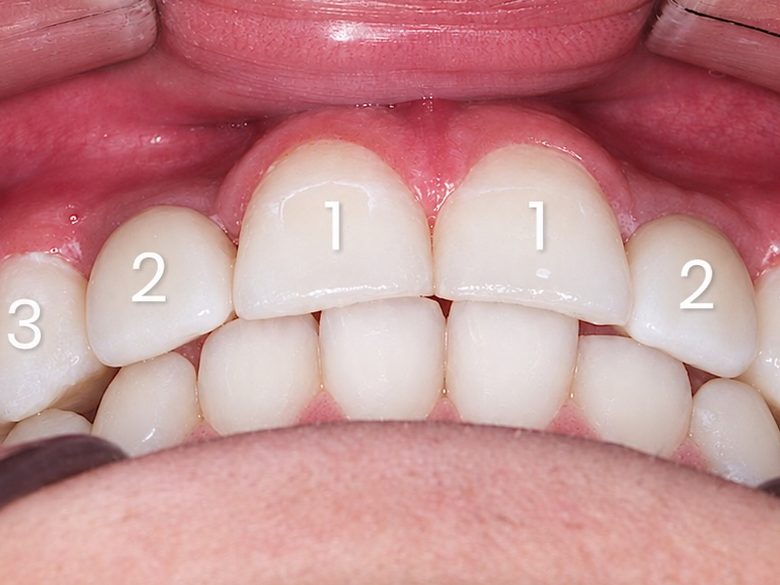 Implant uchun joy ochish, old koʻrinish: hozir