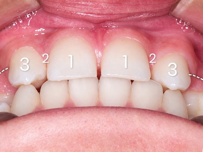 Implant uchun joy ochish, old koʻrinish: oldin